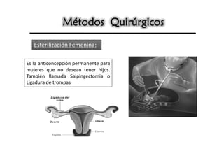 Métodos Quirúrgicos

   Esterilización Femenina:

Es la anticoncepción permanente para
mujeres que no desean tener hijos.
También llamada Salpingectomia o
Ligadura de trompas
 
