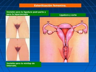 Esterilización femenina.

Incisión para la ligadura post-parto y
para la laparoscopio                        Ligadura y corte




Incisión para la minilap de
intervalo.
 