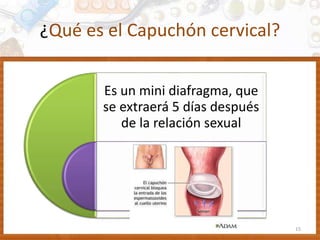 ¿Qué es el Capuchón cervical?
Es un mini diafragma, que
se extraerá 5 días después
de la relación sexual
15
 
