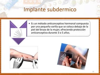 Implante subdermico
19
• Es un método anticonceptivo hormonal compuesta
por una pequeña varilla que se coloca debajo de la
piel del brazo de la mujer, ofreciendo protección
anticonceptiva durante 3 o 5 años.
 