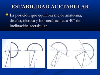 EESSTTAABBIILLIIDDAADD AACCEETTAABBUULLAARR 
 LLaa ppoossiicciióónn qquuee eeqquuiilliibbrraa mmeejjoorr aannaattoommííaa,, 
ddiisseeññoo,, ttééccnniiccaa yy bbiioommeeccáánniiccaa eess aa 4400°° ddee 
iinncclliinnaacciióónn aacceettaabbuullaarr 
 