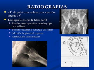 RRAADDIIOOGGRRAAFFIIAASS 
 AAPP ddee ppeellvviiss ccoonn ccaaddeerraass ccoonn rroottaacciióónn 
iinntteerrnnaa 155°° 
 RRaaddiiooggrraaffííaa llaatteerraall ddee ffaallssoo ppeerrffiill 
 PPeerrmmiittee vvaalloorraarr ppoossiicciióónn,, ttaammaaññoo yy ttiippoo 
ddee aacceettáábbuulloo 
 PPeerrmmiittee vviissuuaalliizzaarr llaa ccuurrvvaattuurraa ddeell fféémmuurr 
 SSeelleecccciióónn lloonnggiittuudd ddeell iimmppllaannttee 
 AAmmpplliittuudd ddeell ttúúnneell mmeedduullaarr 
 