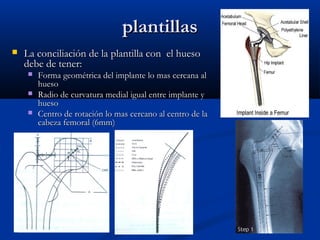 ppllaannttiillllaass 
 LLaa ccoonncciilliiaacciióónn ddee llaa ppllaannttiillllaa ccoonn eell hhuueessoo 
ddeebbee ddee tteenneerr:: 
 FFoorrmmaa ggeeoommééttrriiccaa ddeell iimmppllaannttee lloo mmaass cceerrccaannaa aall 
hhuueessoo 
 RRaaddiioo ddee ccuurrvvaattuurraa mmeeddiiaall iigguuaall eennttrree iimmppllaannttee yy 
hhuueessoo 
 CCeennttrroo ddee rroottaacciióónn lloo mmaass cceerrccaannoo aall cceennttrroo ddee llaa 
ccaabbeezzaa ffeemmoorraall ((66mmmm)) 
 