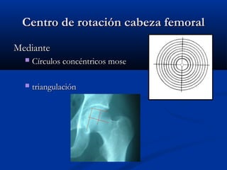 d Centro dee rroottaacciióónn ccaabbeezzaa ffeemmoorraall 
MMeeddiiaannttee 
 CCíírrccuullooss ccoonnccéénnttrriiccooss mmoossee 
 ttrriiaanngguullaacciióónn 
 