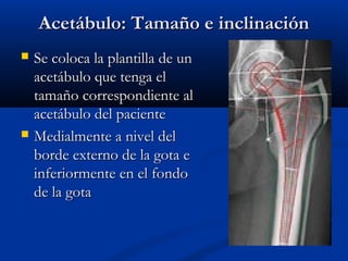 AAcceettáábbuulloo:: TTaammaaññoo ee iinncclliinnaacciióónn 
 SSee ccoollooccaa llaa ppllaannttiillllaa ddee uunn 
aacceettáábbuulloo qquuee tteennggaa eell 
ttaammaaññoo ccoorrrreessppoonnddiieennttee aall 
aacceettáábbuulloo ddeell ppaacciieennttee 
 MMeeddiiaallmmeennttee aa nniivveell ddeell 
bboorrddee eexxtteerrnnoo ddee llaa ggoottaa ee 
iinnffeerriioorrmmeennttee eenn eell ffoonnddoo 
ddee llaa ggoottaa 
 