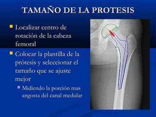 TTAAMMAAÑÑOO DDEE LLAA PPRROOTTEESSIISS 
 LLooccaalliizzaarr cceennttrroo ddee 
rroottaacciióónn ddee llaa ccaabbeezzaa 
ffeemmoorraall 
 CCoollooccaarr llaa ppllaannttiillllaa ddee llaa 
pprróótteessiiss yy sseelleecccciioonnaarr eell 
ttaammaaññoo qquuee ssee aajjuussttee 
mmeejjoorr 
 MMiiddiieennddoo llaa ppoorrcciióónn mmaass 
aannggoossttaa ddeell ccaannaall mmeedduullaarr 
 