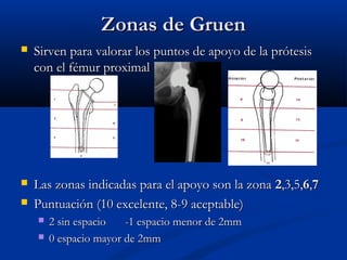 ZZoonnaass ddee GGrruueenn 
 SSiirrvveenn ppaarraa vvaalloorraarr llooss ppuunnttooss ddee aappooyyoo ddee llaa pprróótteessiiss 
ccoonn eell fféémmuurr pprrooxxiimmaall 
 LLaass zzoonnaass iinnddiiccaaddaass ppaarraa eell aappooyyoo ssoonn llaa zzoonnaa 22,,33,,55,,66,,77 
 PPuunnttuuaacciióónn ((1100 eexxcceelleennttee,, 8--99 aacceeppttaabbllee)) 
 22 ssiinn eessppaacciioo --11 eessppaacciioo mmeennoorr ddee 22mmmm 
 00 eessppaacciioo mmaayyoorr ddee 22mmmm 
 