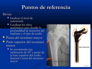 PPuunnttooss ddee rreeffeerreenncciiaa 
SSiirrvveenn 
 llooccaalliizzaarr eell nniivveell ddee 
oosstteeoottoommííaa 
 LLooccaalliizzaarr llooss ssiittiiooss 
aannaattóómmiiccooss ppaarraa ddeecciiddiirr llaa 
pprrooffuunnddiiddaadd ddee iinnsseerrcciióónn ddeell 
iimmppllaannttee yy eell ttiippoo ddee ccuueelllloo 
 PPuunnttaa ddeell ttrrooccáánntteerr mmaayyoorr 
 PPaarrttee ssuuppeerriioorr ddeell ttrrooccáánntteerr 
mmeennoorr 
 SSee rreeccoommiieennddaa uunnaa 
iinncclliinnaacciióónn ddee 5500°° aa ppaarrttiirr ddee 
llaa bbaassee ssuuppeerriioorr ddeell ccuueelllloo 
ffeemmoorraall aa nniivveell ddeell ttrrooccáánntteerr 
mmaayyoorr 
 