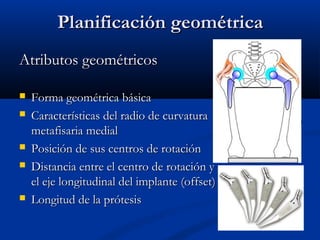 PPllaanniiffiiccaacciióónn ggeeoommééttrriiccaa 
AAttrriibbuuttooss ggeeoommééttrriiccooss 
 FFoorrmmaa ggeeoommééttrriiccaa bbáássiiccaa 
 CCaarraacctteerrííssttiiccaass ddeell rraaddiioo ddee ccuurrvvaattuurraa 
mmeettaaffiissaarriiaa mmeeddiiaall 
 PPoossiicciióónn ddee ssuuss cceennttrrooss ddee rroottaacciióónn 
 DDiissttaanncciiaa eennttrree eell cceennttrroo ddee rroottaacciióónn yy 
eell eejjee lloonnggiittuuddiinnaall ddeell iimmppllaannttee ((ooffffsseett)) 
 LLoonnggiittuudd ddee llaa pprróótteessiiss 
 