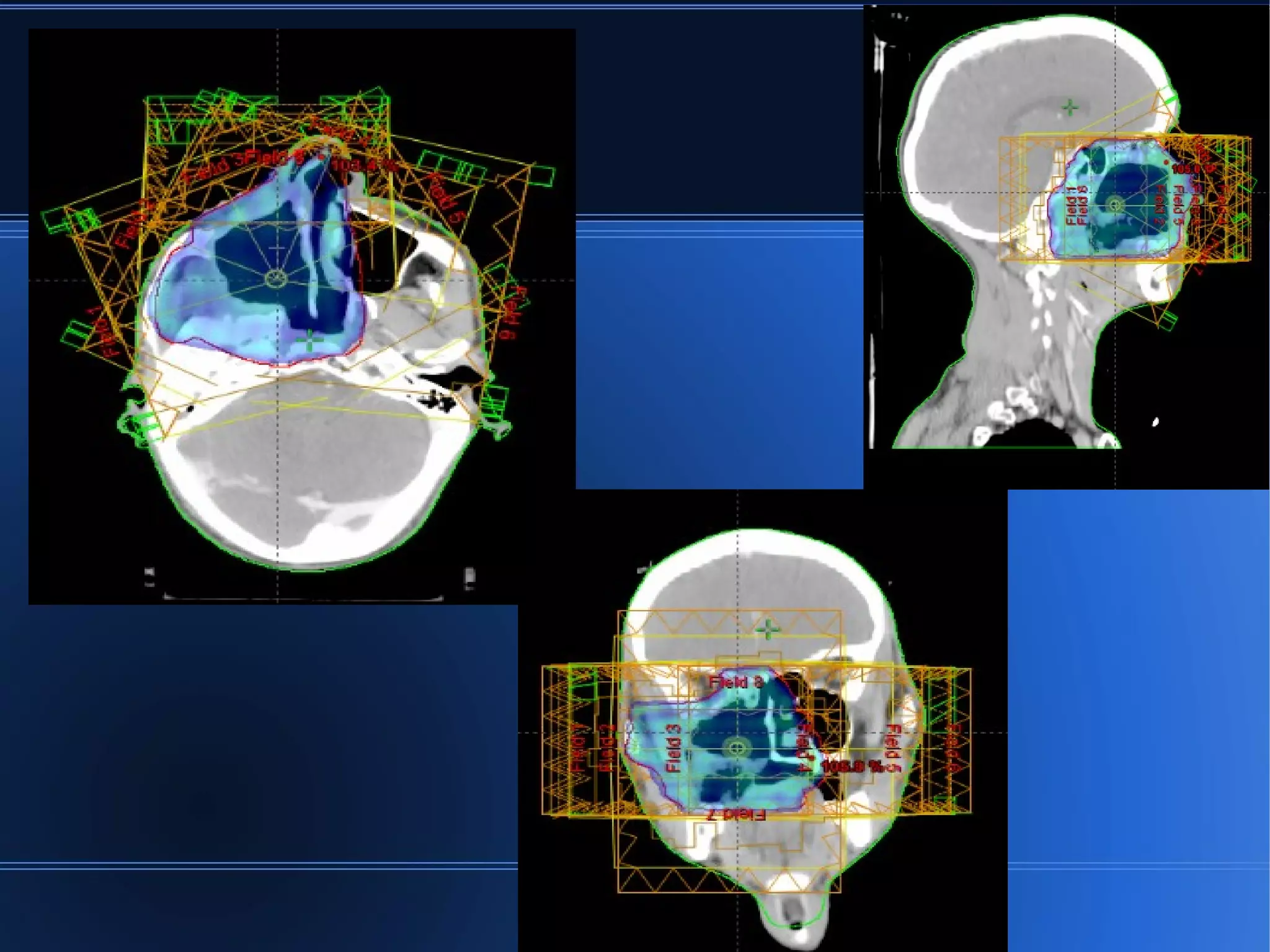 radiotherapy planning of CA maxilla | ODP