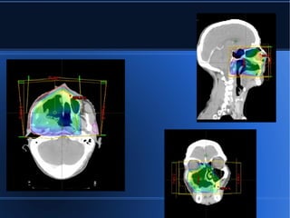 radiotherapy planning of CA maxilla | ODP