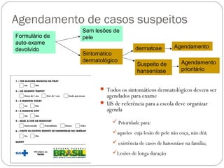 Agendamento de casos suspeitos
                Sem lesões de
Formulário de   pele
auto-exame
                                      dermatose          Agendamento
devolvido
                Sintomático
                dermatológico                                Agendamento
                                       Suspeito de
                                       hanseníase            prioritário


                       Todos os sintomáticos dermatológicos devem ser
                        agendados para exame
                       US de referência para a escola deve organizar
                        agenda
                            Prioridade para:
                           aqueles cuja lesão de pele não coça, não dói;
                            existência de casos de hanseníase na família;
                           Lesões de longa duração
 