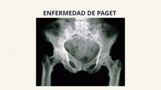 ENFERMEDAD DE PAGET
 