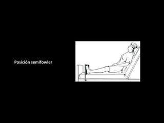 Posición ginecológica o
de litotomía: En decúbito
dorsal con ambas caderas
flexionadas y
discretamente abducidas,
así como...