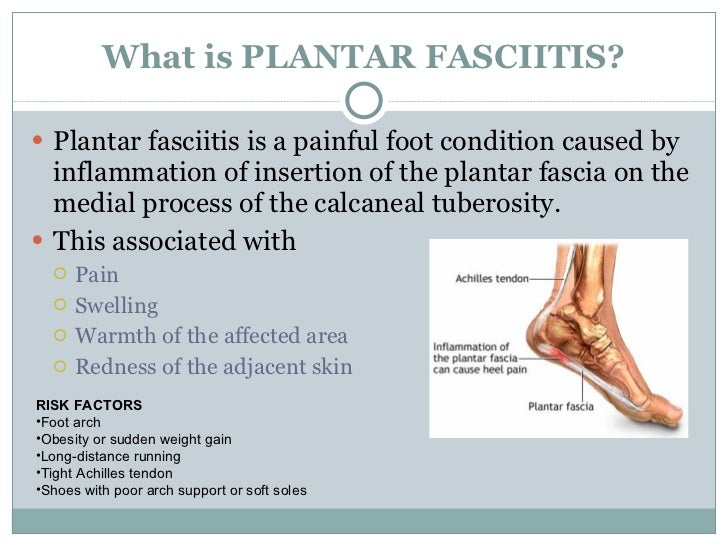 Plantar fasciitis