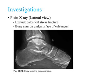Investigations
• Plain X ray (Lateral view)
- Exclude calcaneal stress fracture
- Bony spur on undersurface of calcaneum
 