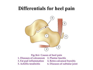 Differentials for heel pain
 