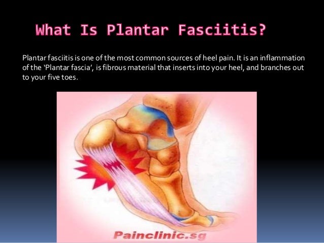 What is plantar faciitis?