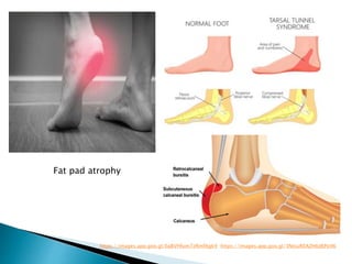 PLANTAR FASCIITIS .pptx. This ppt is based on sports condition plantar ...