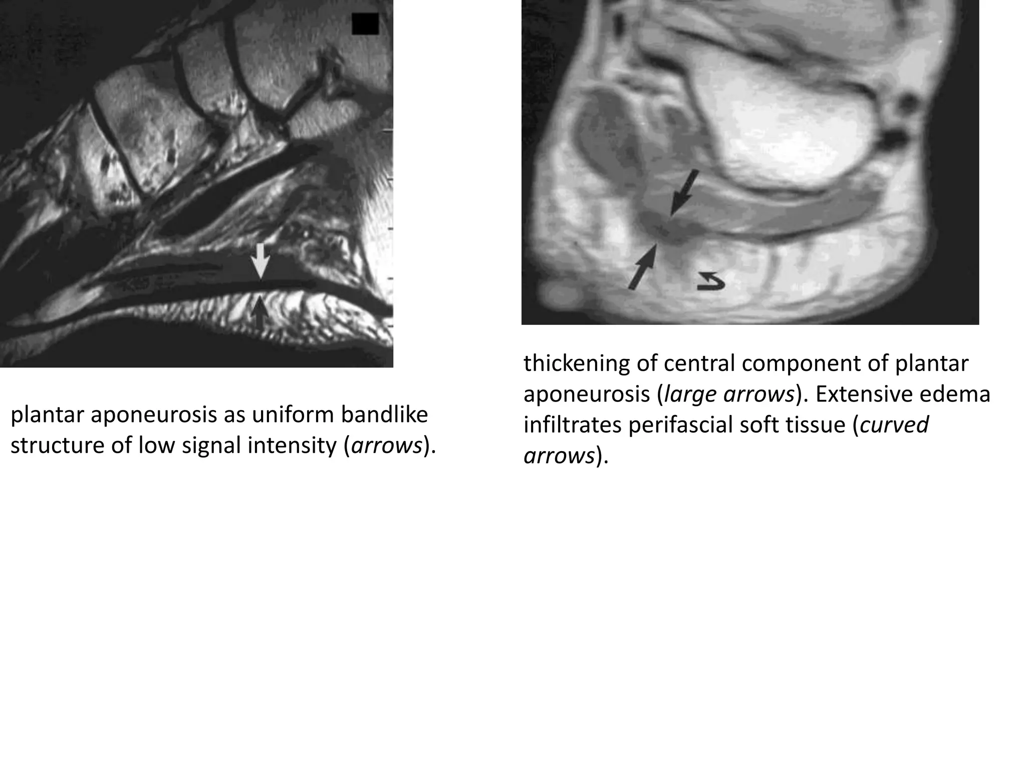 thickening of central component of plantar
                                              aponeurosis (large arrows). Extensive edema
plantar aponeurosis as uniform bandlike       infiltrates perifascial soft tissue (curved
structure of low signal intensity (arrows).   arrows).
 