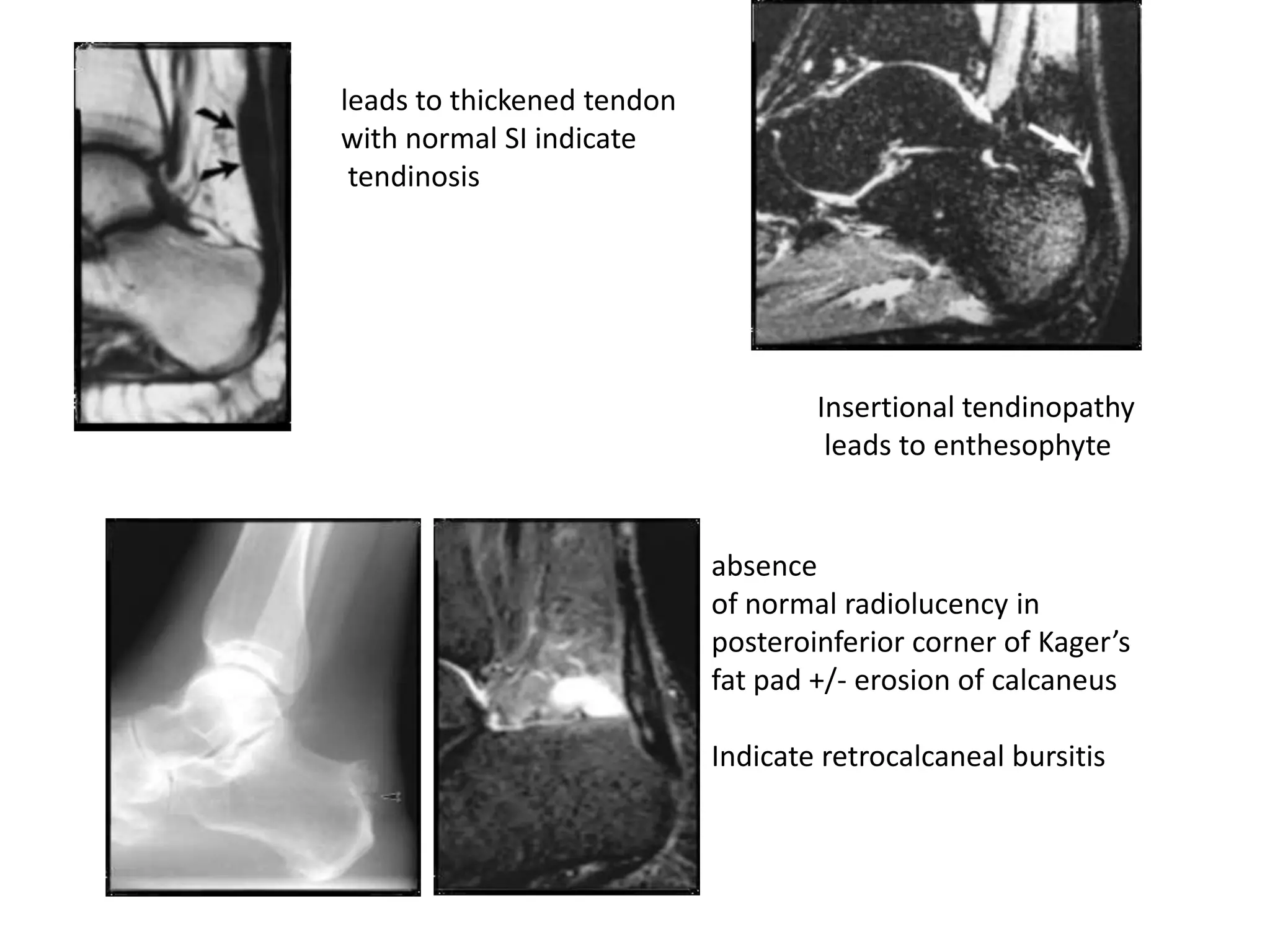 leads to thickened tendon
with normal SI indicate
 tendinosis




                                    Insertional tendinopathy
                                     leads to enthesophyte


                            absence
                            of normal radiolucency in
                            posteroinferior corner of Kager’s
                            fat pad +/- erosion of calcaneus

                            Indicate retrocalcaneal bursitis
 