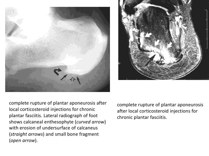 Plantar fascitis final