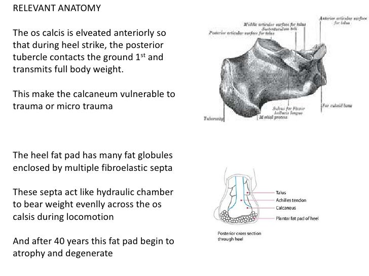 Plantar Fascitis Final plantar-fascitis-final