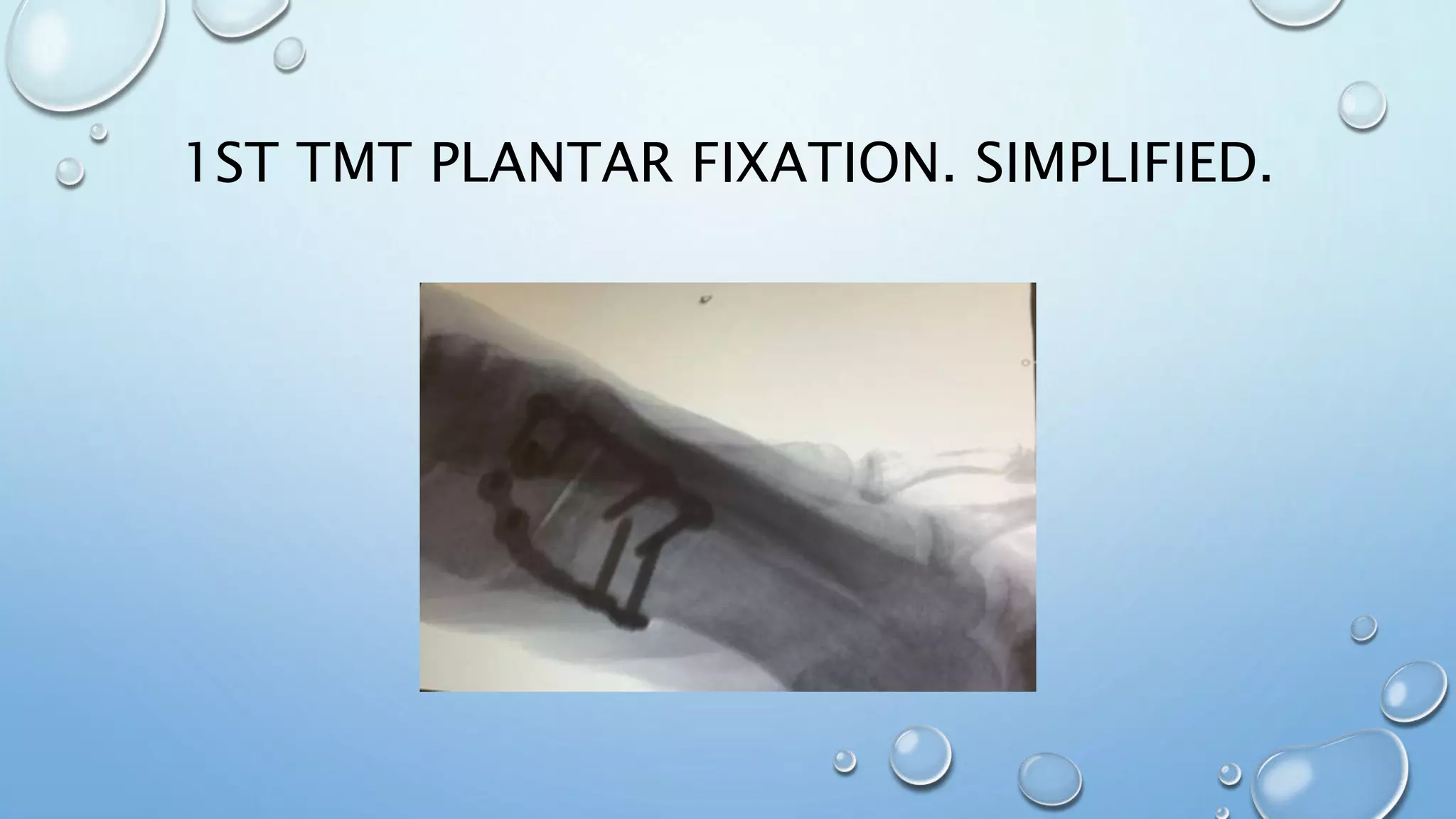 1ST TMT PLANTAR FIXATION. SIMPLIFIED.
 