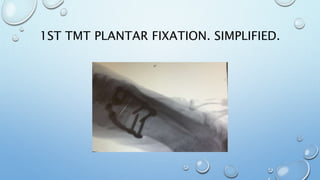 1ST TMT PLANTAR FIXATION. SIMPLIFIED.
 
