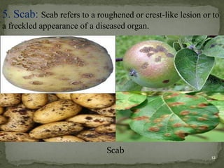 5. Scab: Scab refers to a roughened or crest-like lesion or to
a freckled appearance of a diseased organ.
Scab
12
 