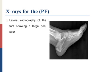 X-rays for the (PF)
 Lateral radiography of the
foot showing a large heel
spur
 