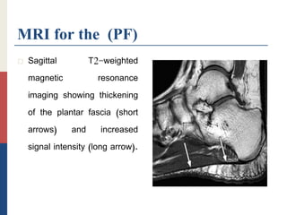 MRI for the (PF)
 Sagittal T2-weighted
magnetic resonance
imaging showing thickening
of the plantar fascia (short
arrows) and increased
signal intensity (long arrow).
 