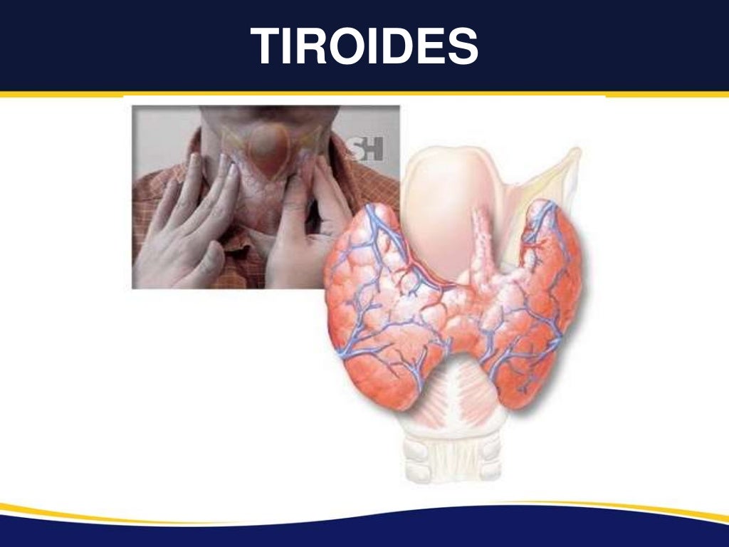 Bethesda II de Tiroides Bethesda II de Tiroides