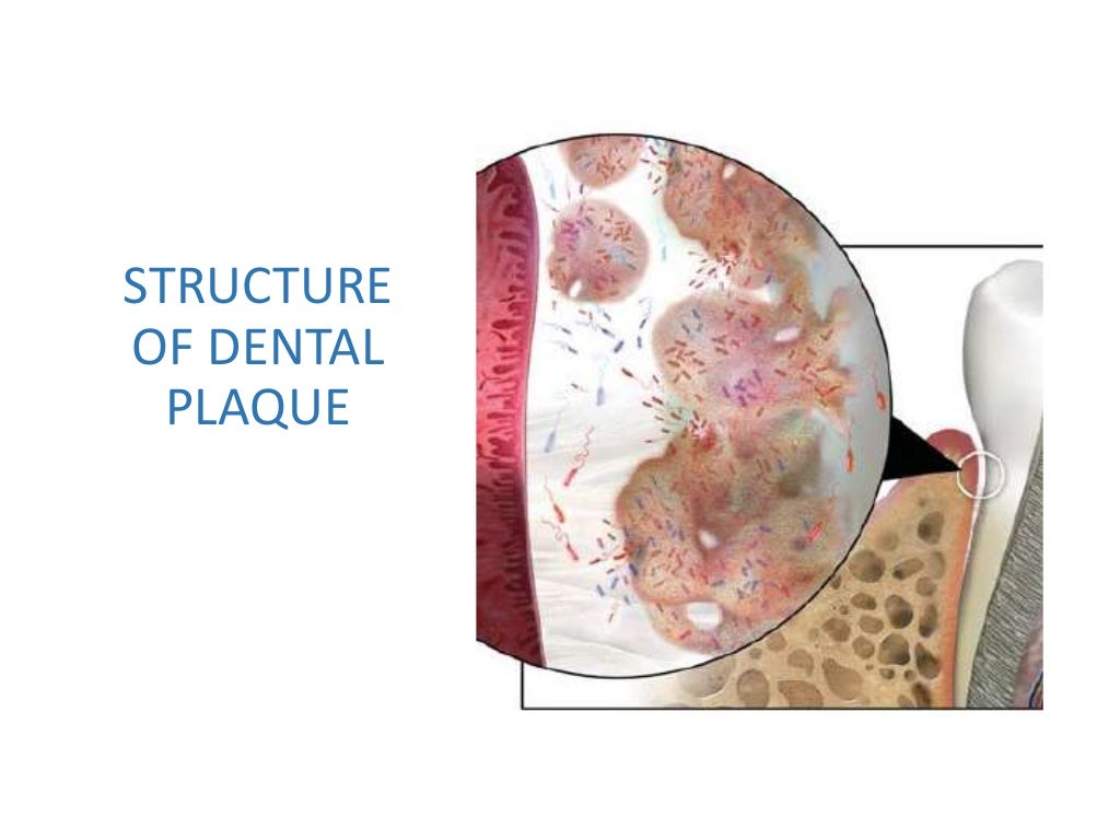 Plaque as a Biofilm