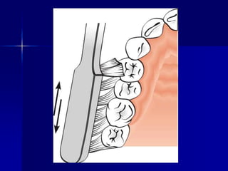 Plaque control | PDF
