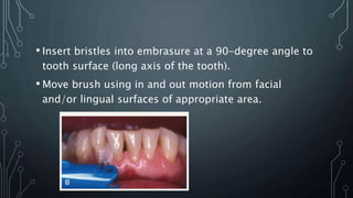 • Insert bristles into embrasure at a 90-degree angle to
tooth surface (long axis of the tooth).
• Move brush using in and out motion from facial
and/or lingual surfaces of appropriate area.
 