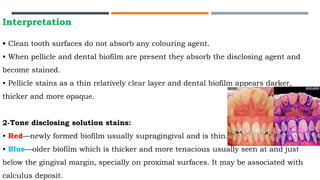 Interpretation
• Clean tooth surfaces do not absorb any colouring agent.
• When pellicle and dental biofilm are present they absorb the disclosing agent and
become stained.
• Pellicle stains as a thin relatively clear layer and dental biofilm appears darker,
thicker and more opaque.
2-Tone disclosing solution stains:
• Red—newly formed biofilm usually supragingival and is thin.
• Blue—older biofilm which is thicker and more tenacious usually seen at and just
below the gingival margin, specially on proximal surfaces. It may be associated with
calculus deposit.
 