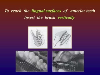 To reach the lingual surfaces of anterior teeth
insert the brush vertically
 