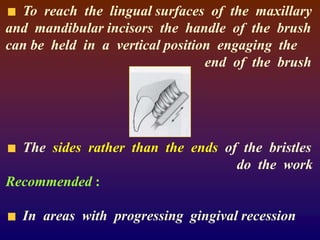 To reach the lingual surfaces of the maxillary
and mandibular incisors the handle of the brush
can be held in a vertical position engaging the
end of the brush
The sides rather than the ends of the bristles
do the work
Recommended :
In areas with progressing gingival recession
 