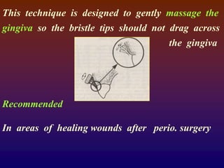 This technique is designed to gently massage the
gingiva so the bristle tips should not drag across
the gingiva
Recommended
In areas of healing wounds after perio. surgery
 