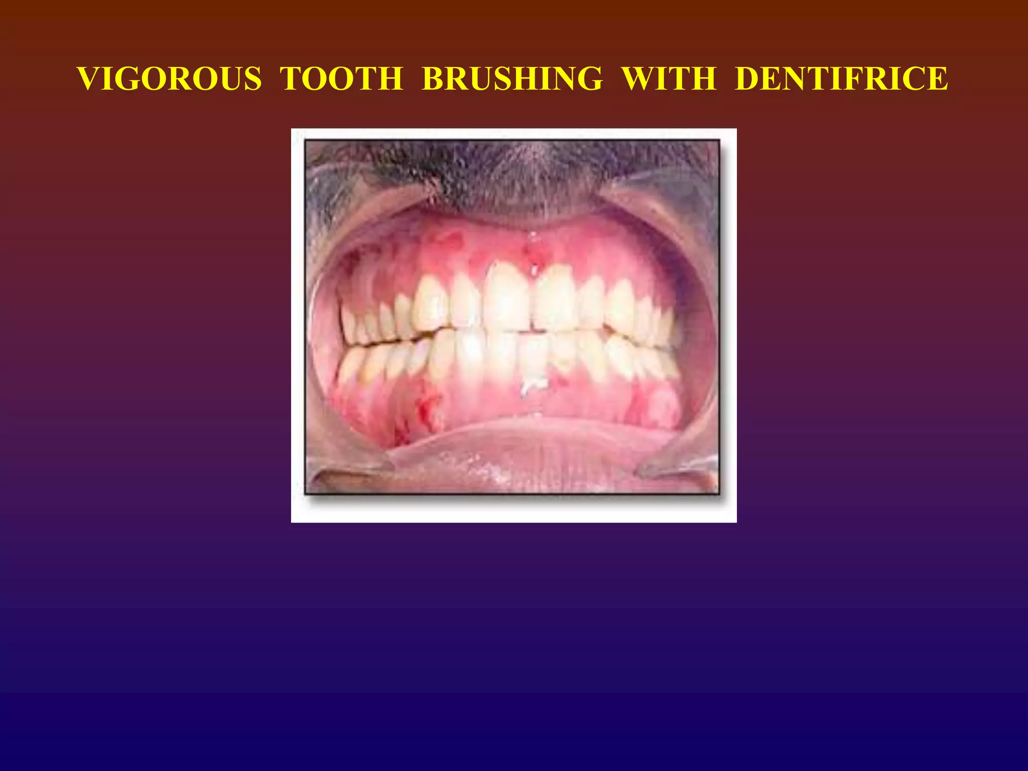 VIGOROUS TOOTH BRUSHING WITH DENTIFRICE
 