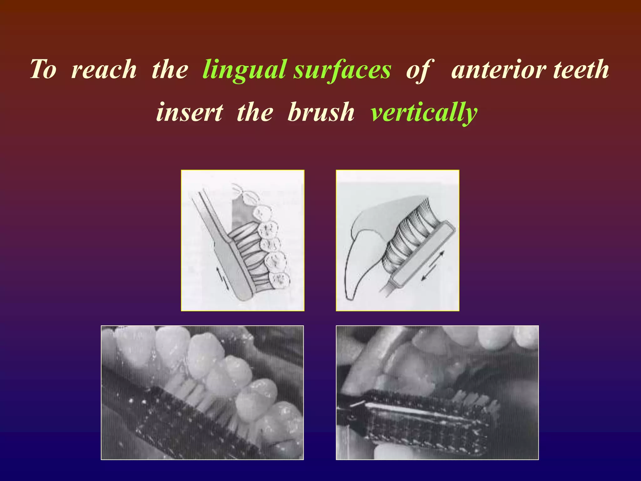 To reach the lingual surfaces of anterior teeth
insert the brush vertically
 