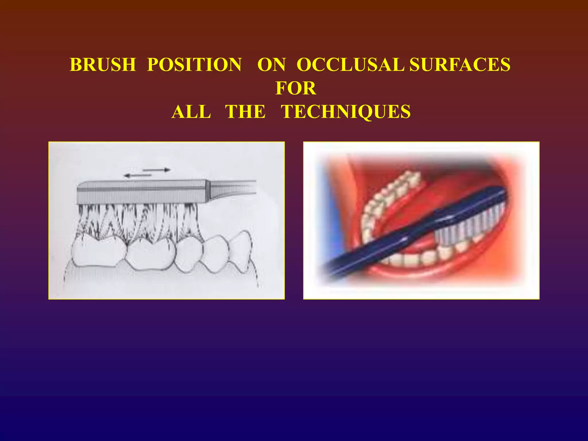 BRUSH POSITION ON OCCLUSAL SURFACES
FOR
ALL THE TECHNIQUES
 