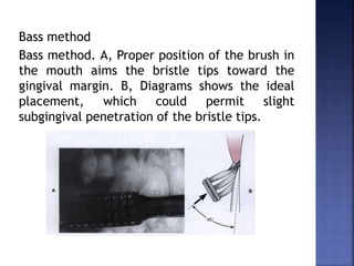 Bass method
Bass method. A, Proper position of the brush in
the mouth aims the bristle tips toward the
gingival margin. B, Diagrams shows the ideal
placement, which could permit slight
subgingival penetration of the bristle tips.
 