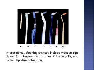 Interproximal cleaning devices include wooden tips
(A and B), interproximal brushes (C through F), and
rubber tip stimulators (G).
 