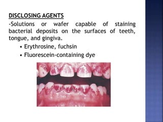 DISCLOSING AGENTS
-Solutions or wafer capable of staining
bacterial deposits on the surfaces of teeth,
tongue, and gingiva.
• Erythrosine, fuchsin
• Fluorescein-containing dye
 