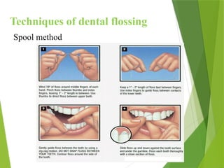 Techniques of dental flossing
Spool method
 