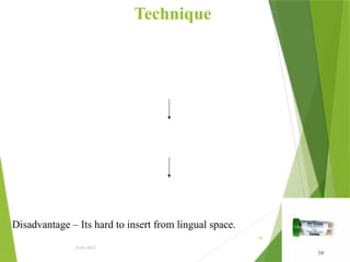 Technique
23-01-2012
59
Disadvantage – Its hard to insert from lingual space.
59
 