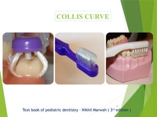 79
COLLIS CURVE
Text book of pediatric dentistry – Nikhil Marwah ( 3rd
edition )
 
