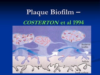 Plaque Biofilm –
COSTERTON et al 1994
 